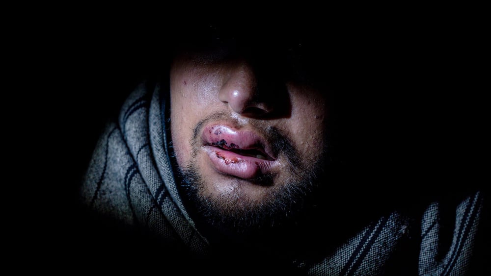 Die Vorwürfe sind nicht neu: Die Lippen des 17-jährigen Hammad aus Pakistan sind blutig und verschwollen, nachdem er im November 2018 von kroatischen Polizisten mit einem Stock verprügelt wurde. © Alessio Mamo