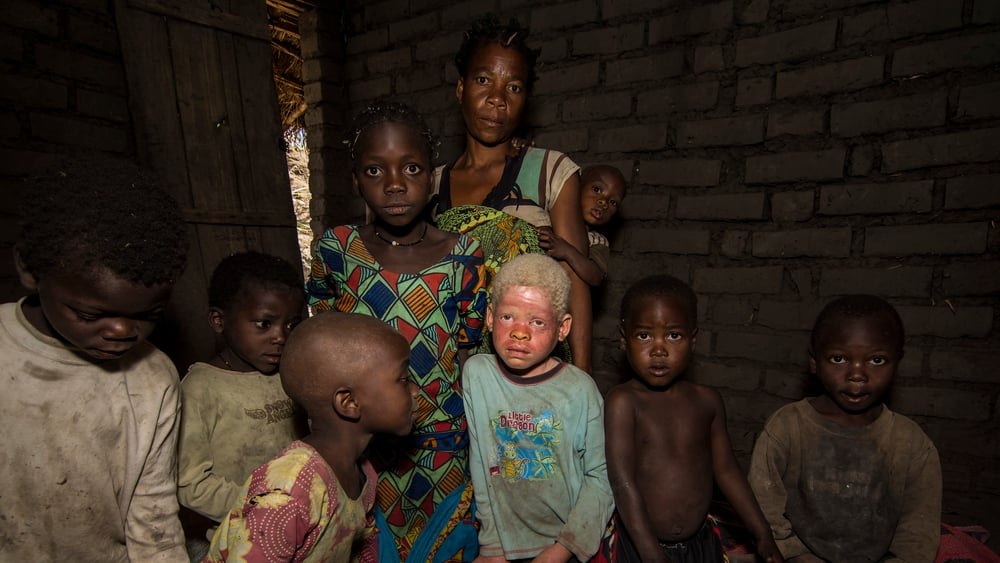 Depuis novembre 2014, au moins 14 personnes atteintes d'albinisme ont été assassinées, leurs membres sont utilisés dans des pratiques rituelles.© LAWILINK/Amnesty International