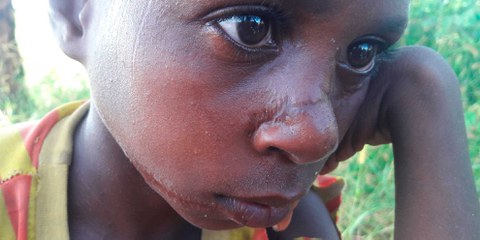 Bewaffnete Männer verletzten diesen 8-jährigen Jungen mit einer Machete – und dies ist noch eine der vergleichweise "harmloseren" Verletzungen, die Kinder in Nigeria in diesem Konflikt erleiden müssen. ©Amnesty International