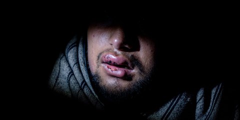 Die Vorwürfe sind nicht neu: Die Lippen des 17-jährigen Hammad aus Pakistan sind blutig und verschwollen, nachdem er im November 2018 von kroatischen Polizisten mit einem Stock verprügelt wurde. © Alessio Mamo