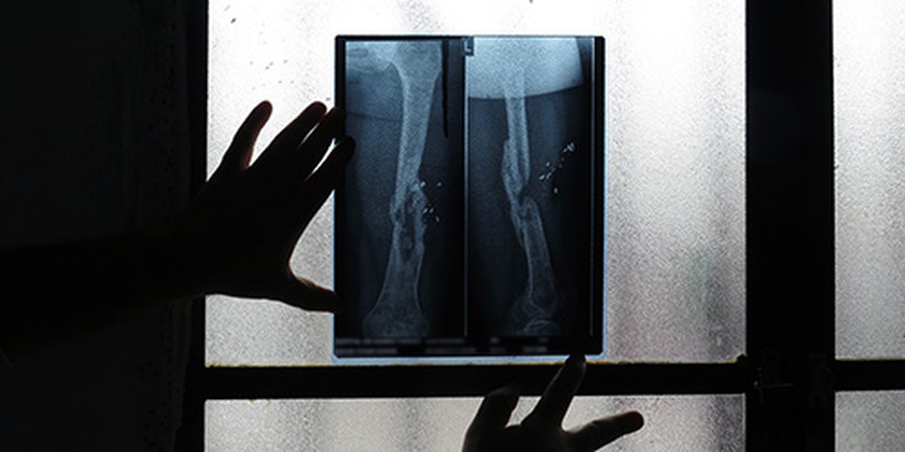 Radiographie d’une femme syrienne blessée par des tireurs d’élite, alors qu’elle faisait ses courses en 2011 © Amnesty International