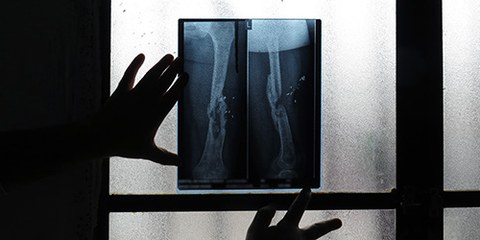 Radiographie d’une femme syrienne blessée par des tireurs d’élite, alors qu’elle faisait ses courses en 2011 © Amnesty International