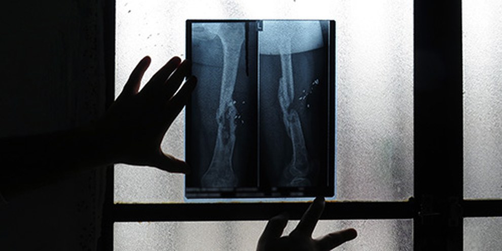 Radiografia di una donna siriana rifugiata, colpita da tiratori scelti nel 2011 © AI